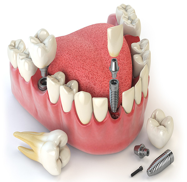b2ap3_large_dental-implants