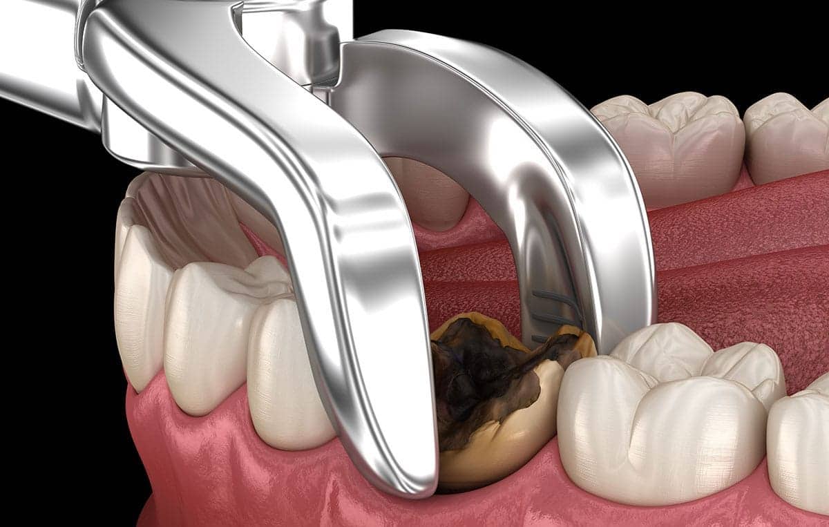 tooth-extraction-healing